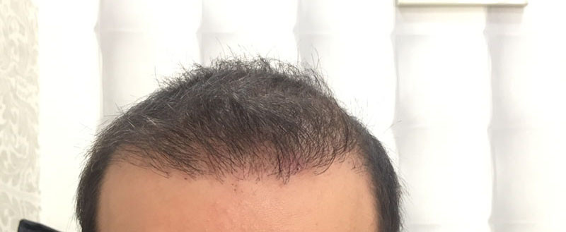 hair-transplant-review-istanbul (12)