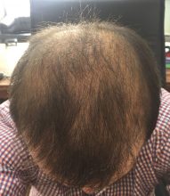 hair-transplant-review-istanbul (13)