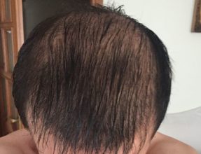 hair-transplant-review-istanbul (15)
