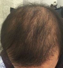 hair-transplant-review-istanbul (16)