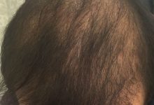 hair-transplant-review-istanbul (16)