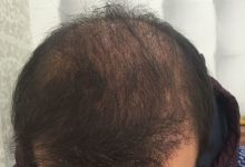 hair-transplant-review-istanbul (17)
