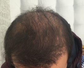 hair-transplant-review-istanbul (17)