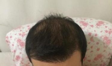 hair-transplant-review-istanbul (18)