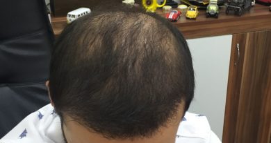 hair-transplant-review-istanbul (19)