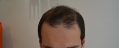 hair-transplant-review-istanbul (2)