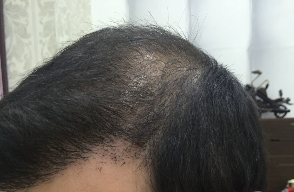 hair-transplant-review-istanbul (20)