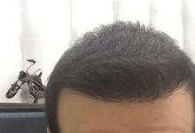 hair-transplant-review-istanbul (21)