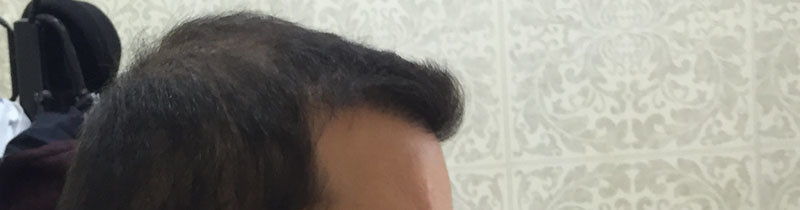 hair-transplant-review-istanbul (22)