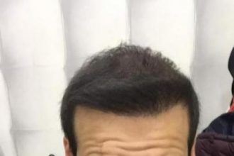 hair-transplant-review-istanbul (23)