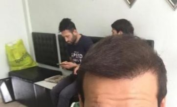 hair-transplant-review-istanbul (24)