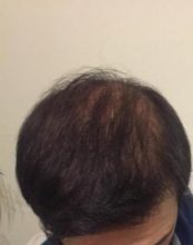 hair-transplant-review-istanbul (26)