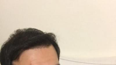 hair-transplant-review-istanbul (28)