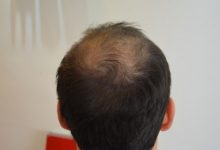 hair-transplant-review-istanbul (3)