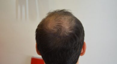 hair-transplant-review-istanbul (3)