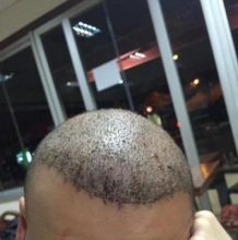 hair-transplant-review-istanbul (5)