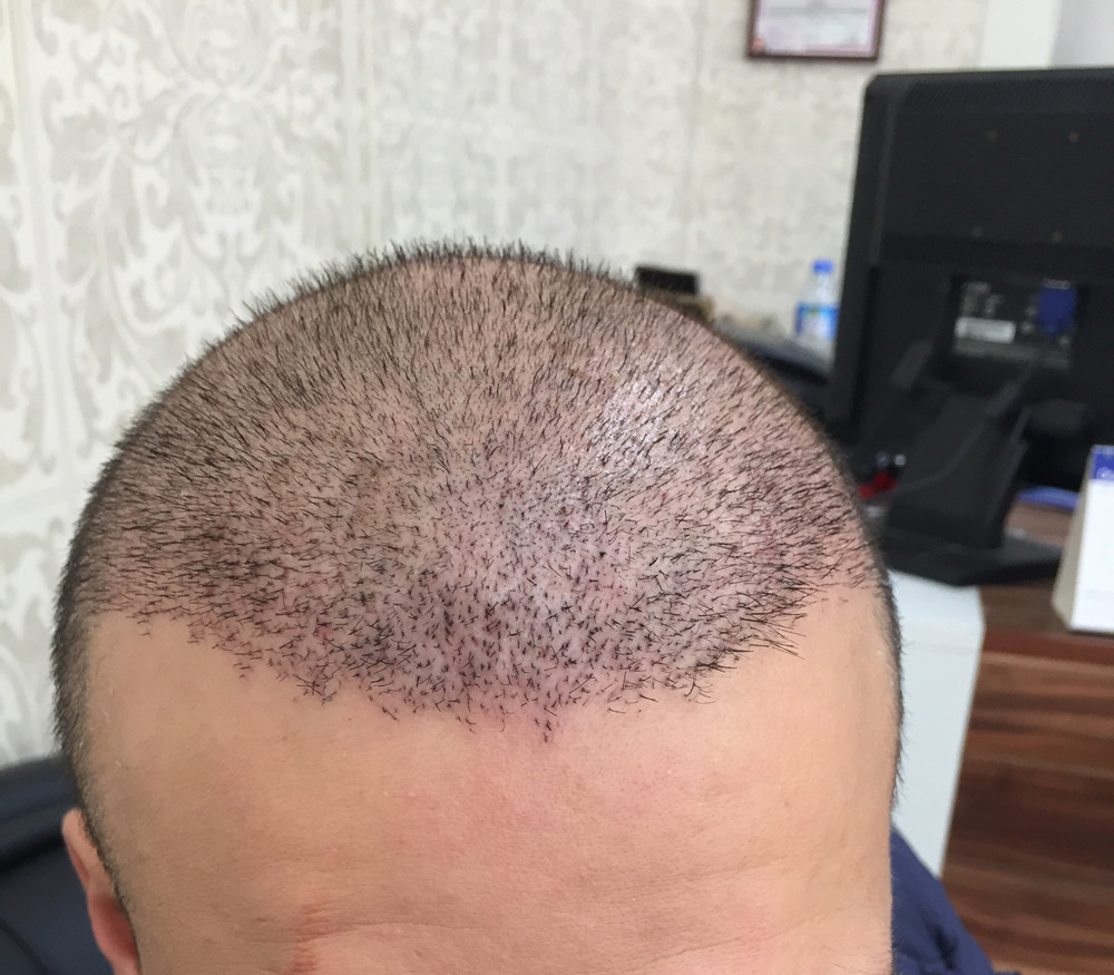 hair-transplant-review-istanbul (6)