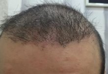 hair-transplant-review-istanbul (7)