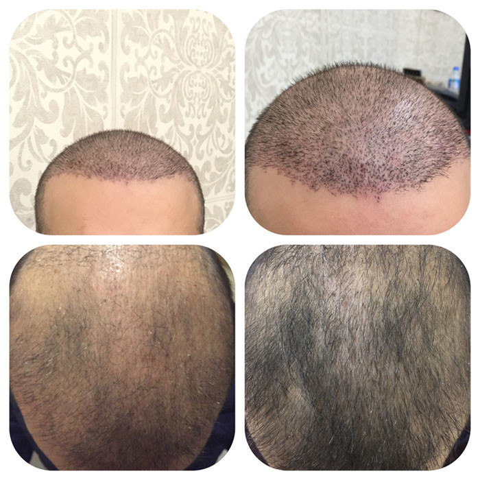hair-transplant-review-istanbul (8)