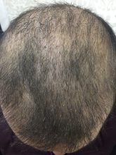hair-transplant-review-istanbul (9)