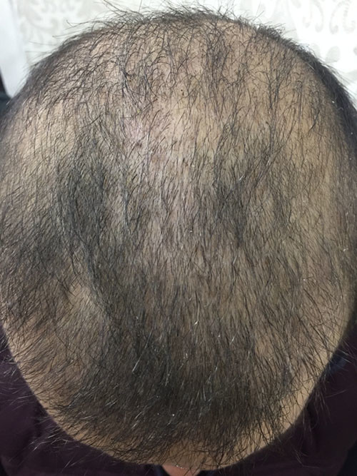 hair-transplant-review-istanbul (9)