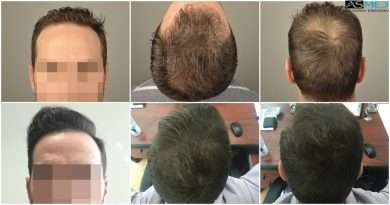 hair-transplant-turkey-forum (1)