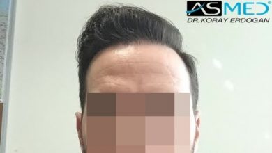 hair-transplant-turkey-forum (1)