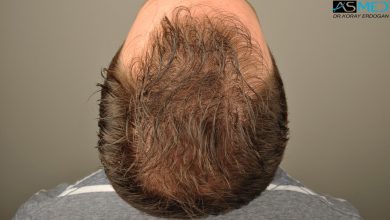 hair-transplant-turkey-forum (10)