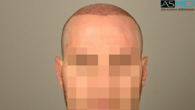 hair-transplant-turkey-forum (11)