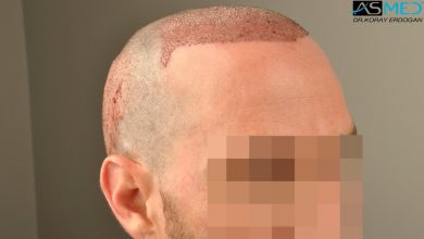 hair-transplant-turkey-forum (12)