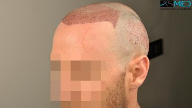 hair-transplant-turkey-forum (13)