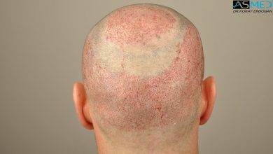 hair-transplant-turkey-forum (14)