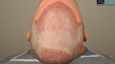 hair-transplant-turkey-forum (15)