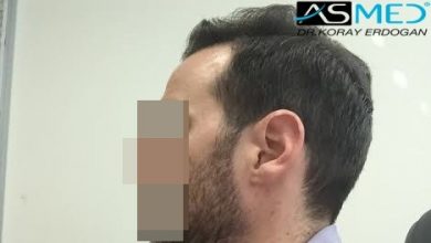 hair-transplant-turkey-forum (2)