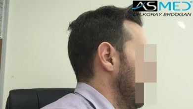 hair-transplant-turkey-forum (3)