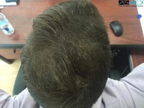 hair-transplant-turkey-forum (5)