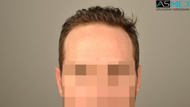 hair-transplant-turkey-forum (6)