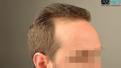 hair-transplant-turkey-forum (7)