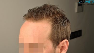 hair-transplant-turkey-forum (8)