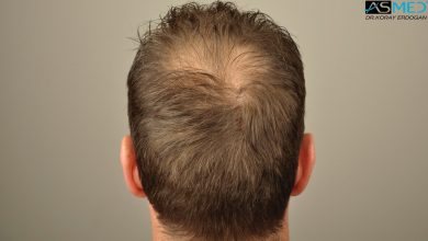 hair-transplant-turkey-forum (9)