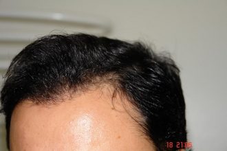 Hair-transplant-real-results-turkey (1)