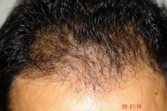 Hair-transplant-real-results-turkey (11)