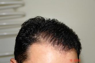 Hair-transplant-real-results-turkey (13)