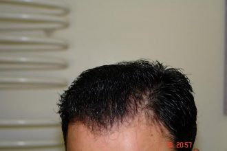 Hair-transplant-real-results-turkey (14)
