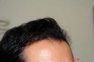 Hair-transplant-real-results-turkey (15)