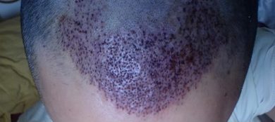 Hair-transplant-real-results-turkey (2)