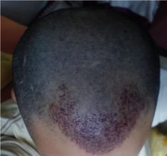 Hair-transplant-real-results-turkey (3)