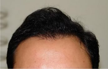 Hair-transplant-real-results-turkey (4)