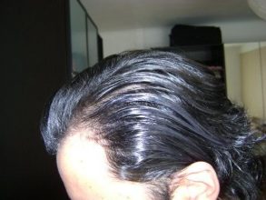 Hair-transplant-real-results-turkey (5)
