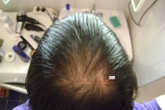Hair-transplant-real-results-turkey (6)